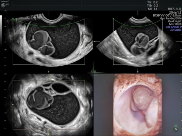 Jak 3D ultrazvuk pomáhá řešit šest běžných gynekologických problémů